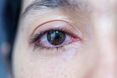 6 Penyebab Mata Berair, Bisa Jadi Tanda Infeksi