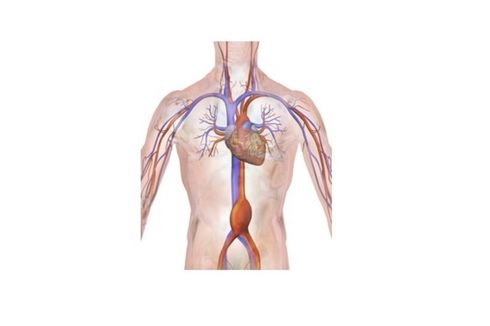 Aneurisma Aorta