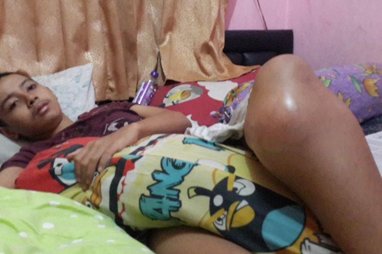 Jaka Natasha Dewantara (15) terbaring lemas akibat tumor tulang di atas sebuah ranjang di rumahnya, Jalan Ciwulan 29A Kelurahan Purwantoro, Kecamatan Blimbing, Kota Malang, Rabu (3/5/2017).