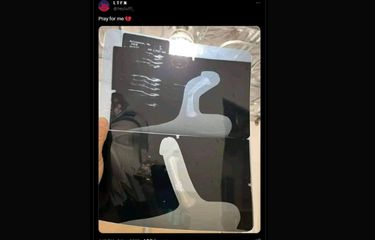 Ramai soal Foto Penis Patah, Dokter Boyke Ungkap Penyebab dan Cara ...