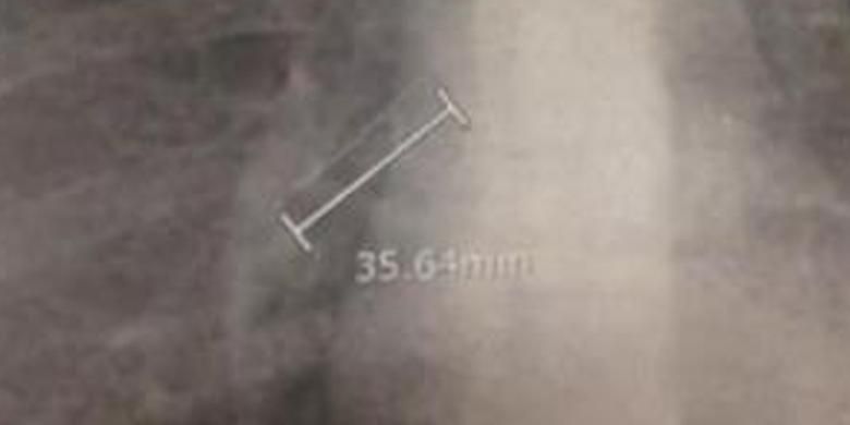 Foto jarum pentul yang bersarang di dekat paru-paru Kathleen.