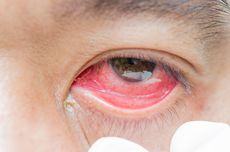 Cara Mengobati Sakit Mata karena Infeksi yang Penting Diperhatikan