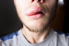 Angioedema