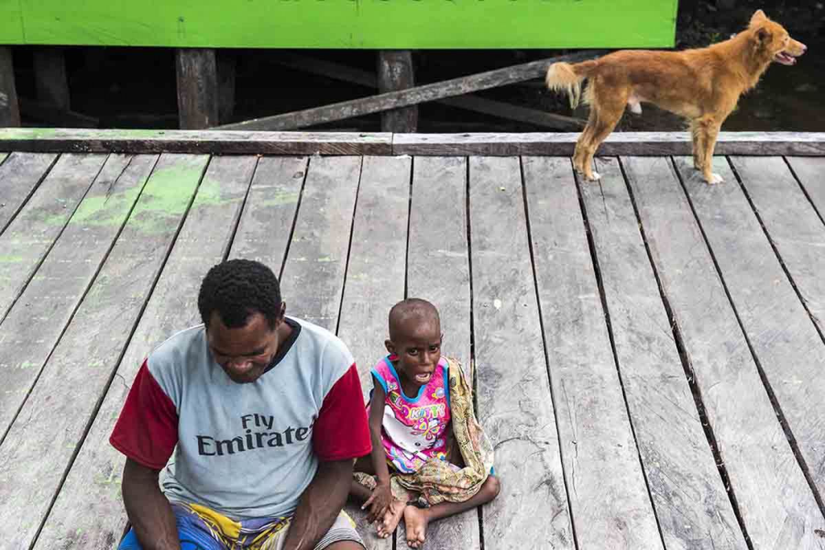 Seorang bapak mendampingi anaknya yang telah melewati perawatan di Rumah Sakit Umum Daerah (RSUD) Agats, Kabupaten Asmat, Papua, Sabtu (27/1/2018). Minimnya ketidaktahuan memilih, mengolah, menyajikan pangan yang ada menjadi sumber gizi, sarana kesehatan dan ketidakmampuan mengakses makanan menjadi salah satu pemicu warga di Kabupaten Asmat terkena wabah campak dan gizi buruk.