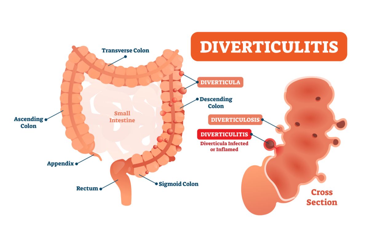 Ilustrasi diverkulitis