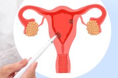 7 Faktor Risiko Kanker Endometrium yang Perlu Anda Ketahui