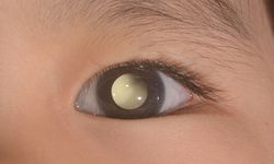 Dosen UMY: Retinoblastoma, Kanker Mata Terbanyak pada Anak