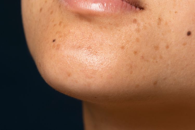 Flek hitam tak kunjung hilang meski rajin skincare-an? Bisa jadi kamu melakukan kesalahan ini saat merawat wajah. Simak selengkapnya.