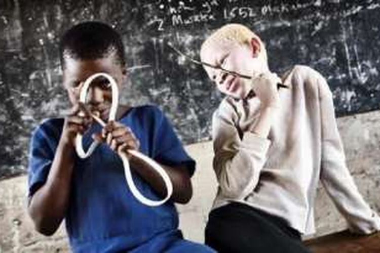 Albino rentan diculik untuk dibunuh di beberapa negara di Afrika, termasuk Malawi dan Mozambik.