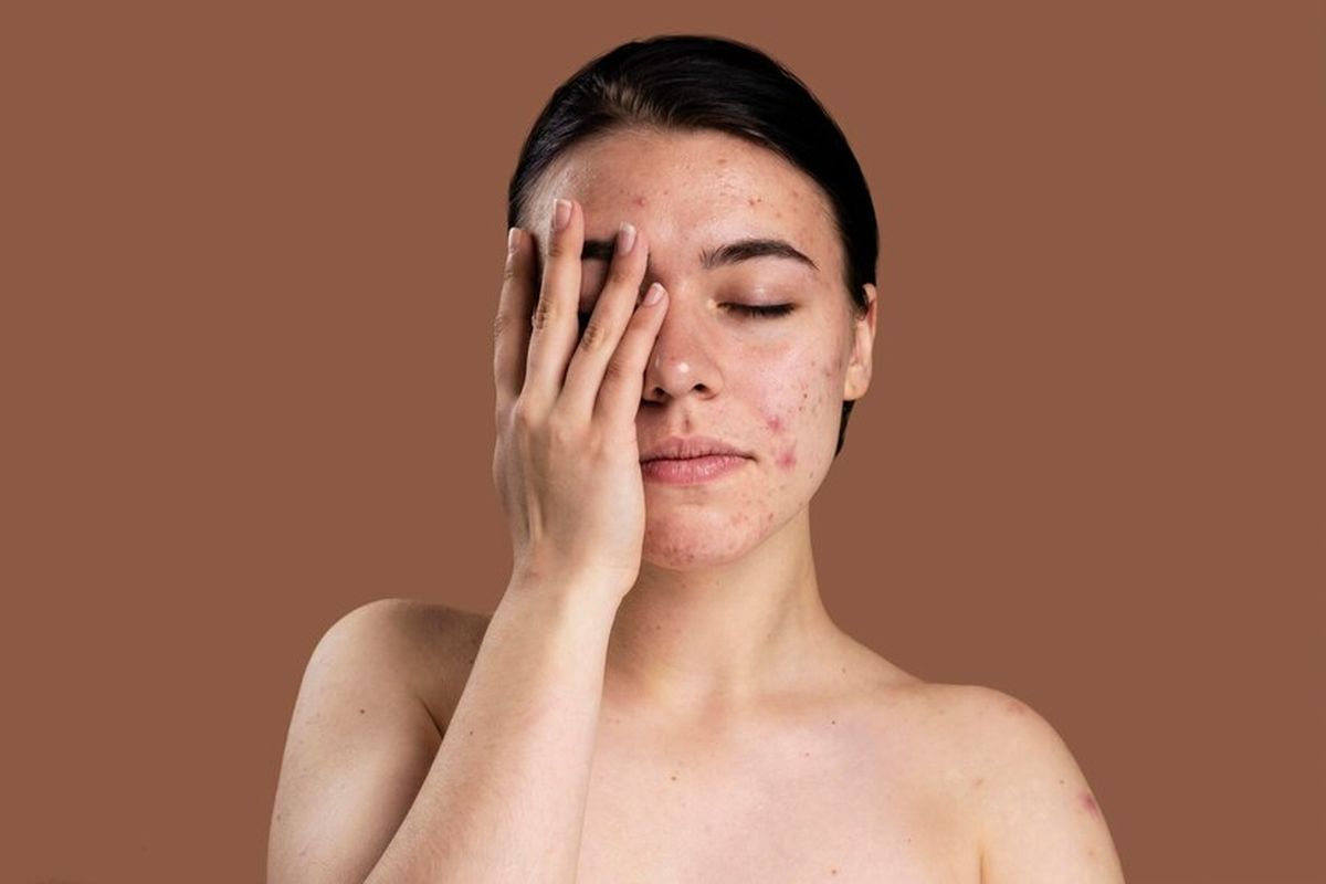 Ilustrasi wanita dengan kulit berjerawat