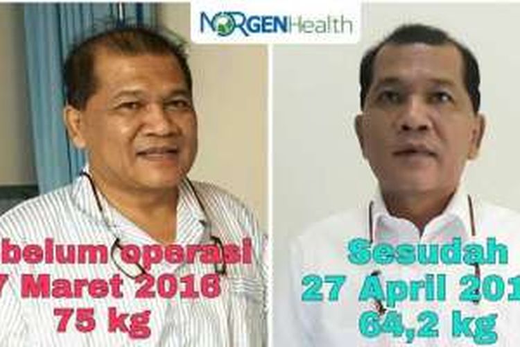 Sihol Manulang (54), penderita diabetes yang setelah menjalani operasi, gula darah normal seakan tidak pernah diabetes.