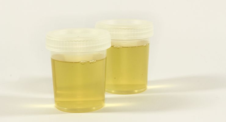 Peneliti Akhirnya Temukan Jawaban Mengapa Urine Berwarna Kuning
