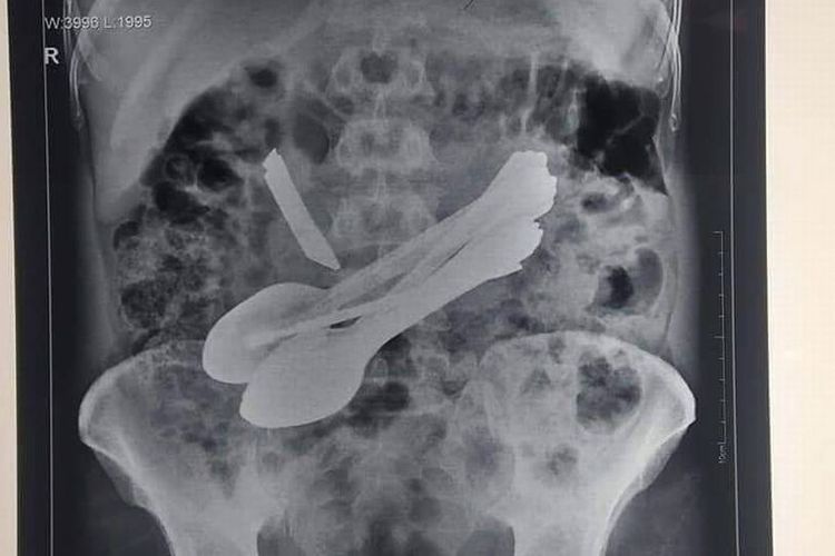 Inilah hasil sinar X yang memperlihatkan perut seorang pria di India. Di dalamnya, dokter menemukan benda seperti obeng hingga sendok.