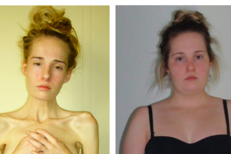 Tangkapan layar unggahan instagram Gemma Walker saat menderita anoreksia dan bulimia