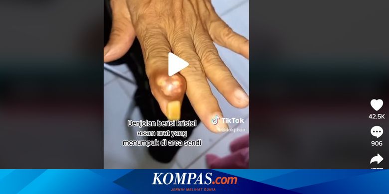 Mengenal Tophi, Komplikasi akibat Asam Urat yang Tidak Segera Diobati