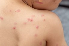 Remaja Suspek Monkeypox di Kalbar Membaik dan Dipastikan Mengidap Cacar Air
