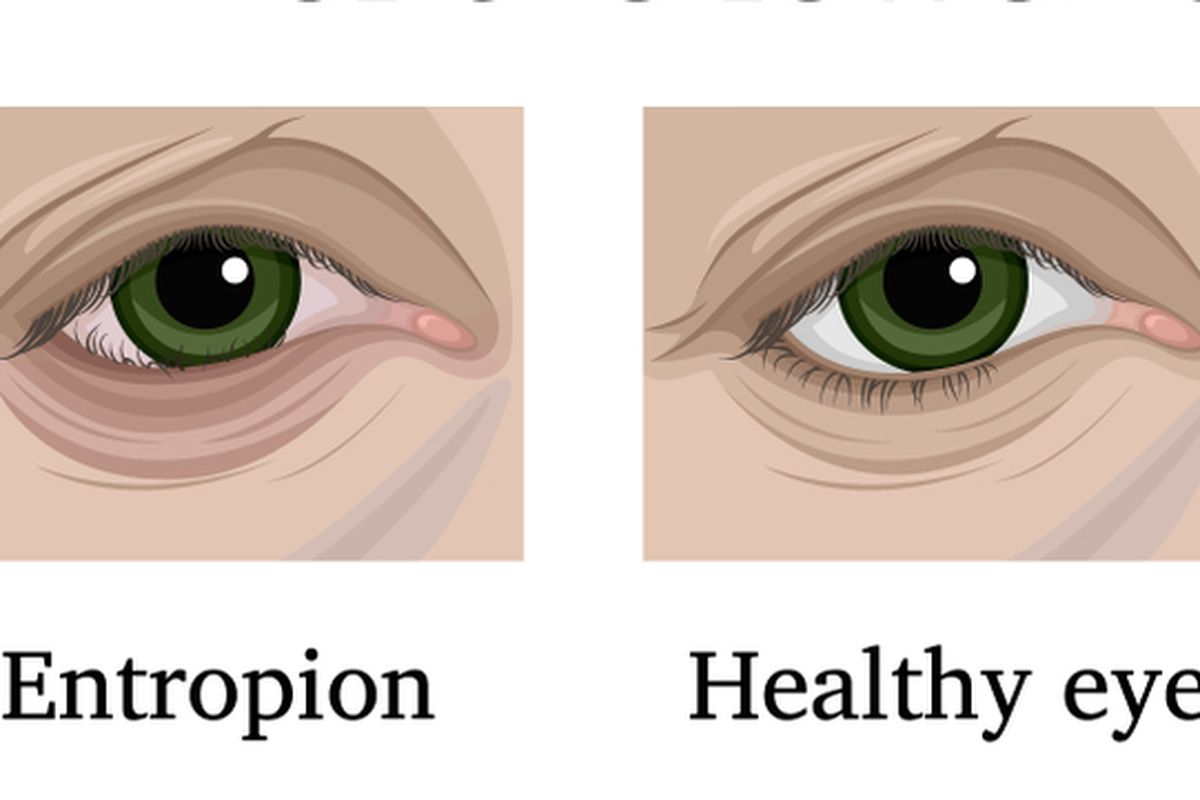 Ilustrasi entropion dan ektropion