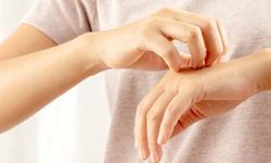 Cara Mengobati Scabies pada Manusia secara Alami dan Pakai Obat
