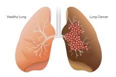 4 Gejala Kanker Paru-paru Sesuai Jenisnya