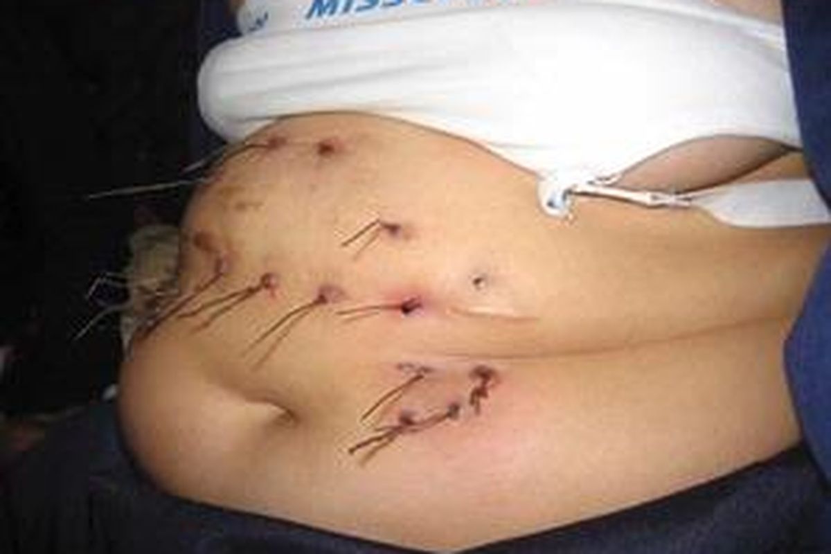 Belasan kawat keluar dari perut Noorsyaidah, ketika ditemui di rumahnya di Samarinda, Kalimantan Timur.