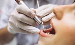 Solusi Atasi Gigi Berlubang, dari Penambalan hingga Perawatan Fluoride