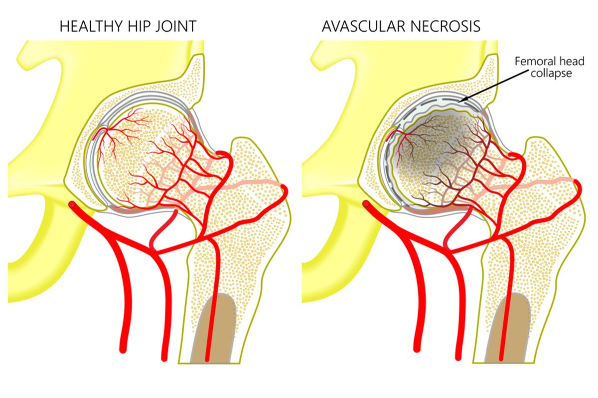 ilustrasi avascular necrosis