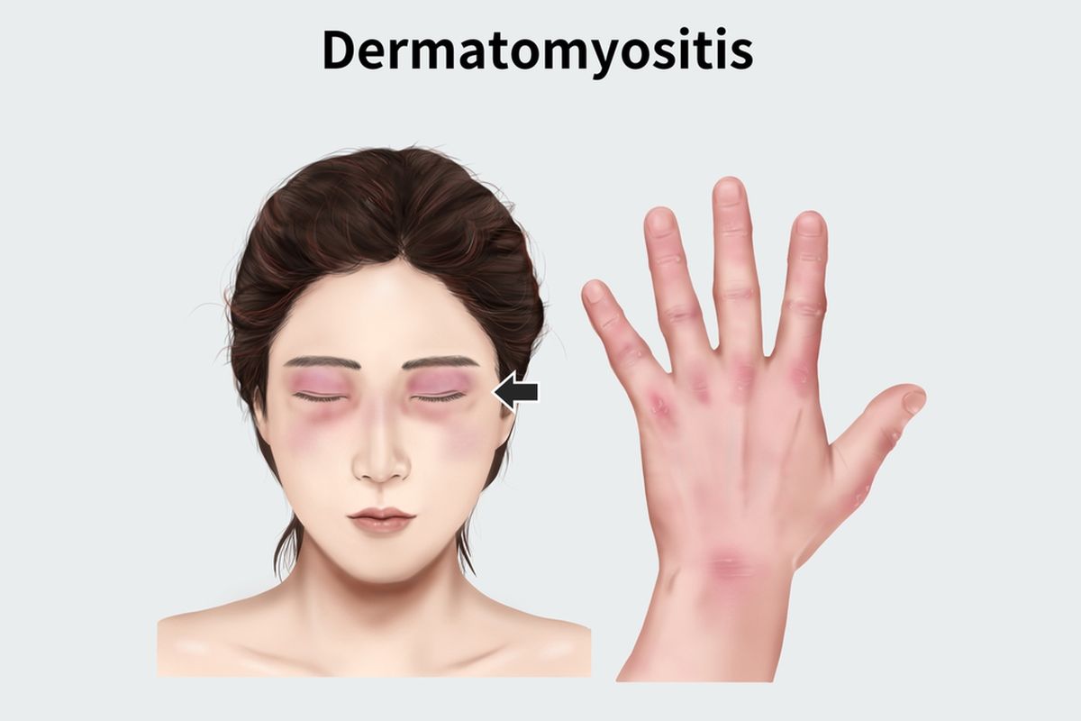 Ilustrasi Dermatomiositis