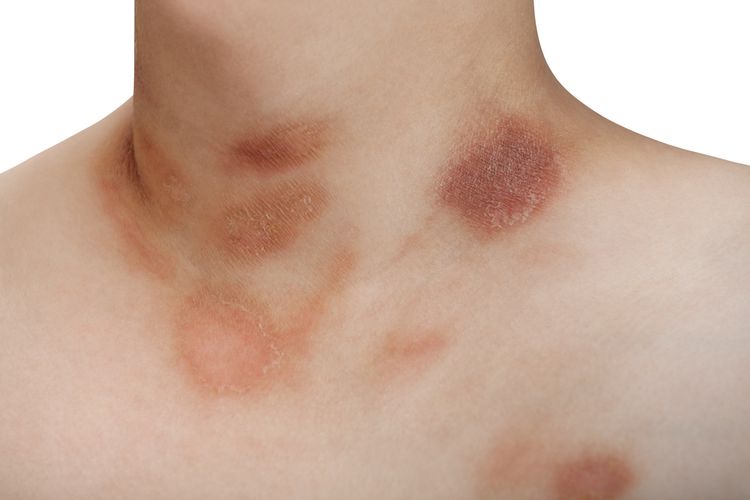 Ilustrasi Pityriasis Rosea