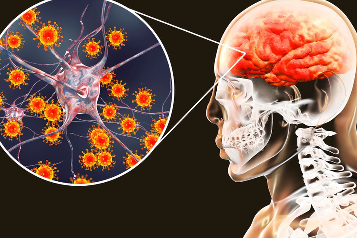 Ilustrasi radang otak, meningitis