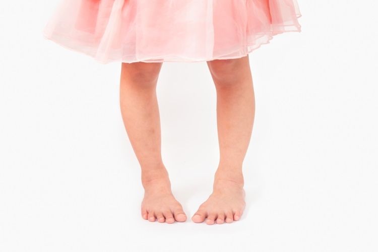 Ilustrasi kondisi kaki O atau bow legs pada anak. 