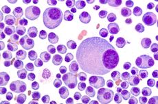 Kenali Multiple Myeloma, Jenis Kanker Darah yang Sulit Didiagnosis