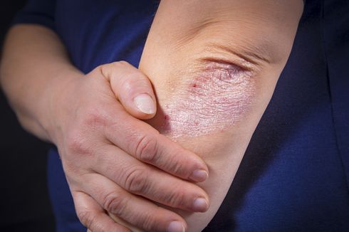 Kenali Apa Itu Penyakit Psoriasis Vulgaris, Penyebab, dan Gejalanya