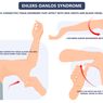 Sindrom Ehlers-Danlos