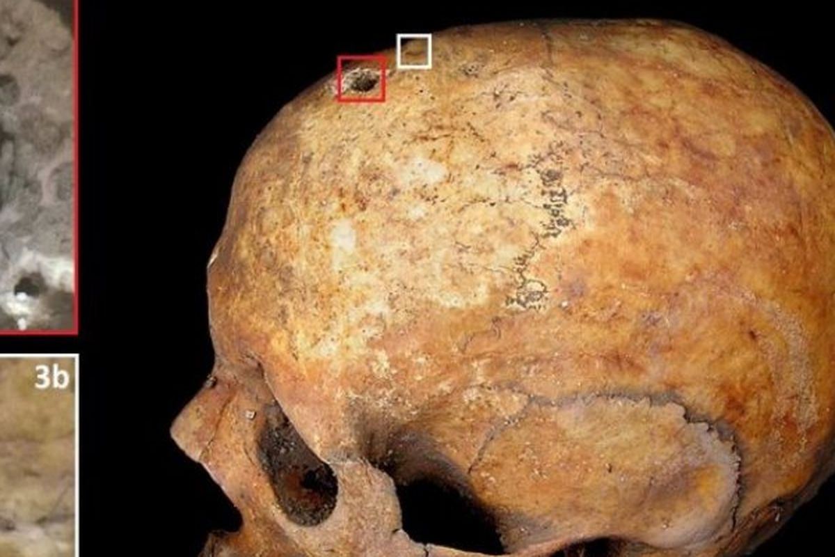 Trepanasi, pengeboran di kepala yang dipercaya dapat mengobati berbagai penyakit.