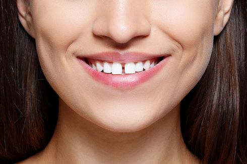 6 Penyebab Gigi Renggang dan Cara Mengatasinya