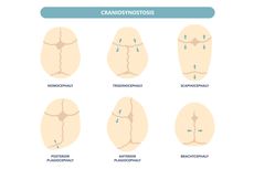 Craniosynostosis