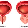 7 Cara Mengobati Prostatitis dengan Obat, Perawatan Medis, dan Alami