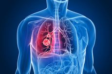 6 Mitos tentang Risiko Kanker Paru-paru, Jangan Lagi Percaya