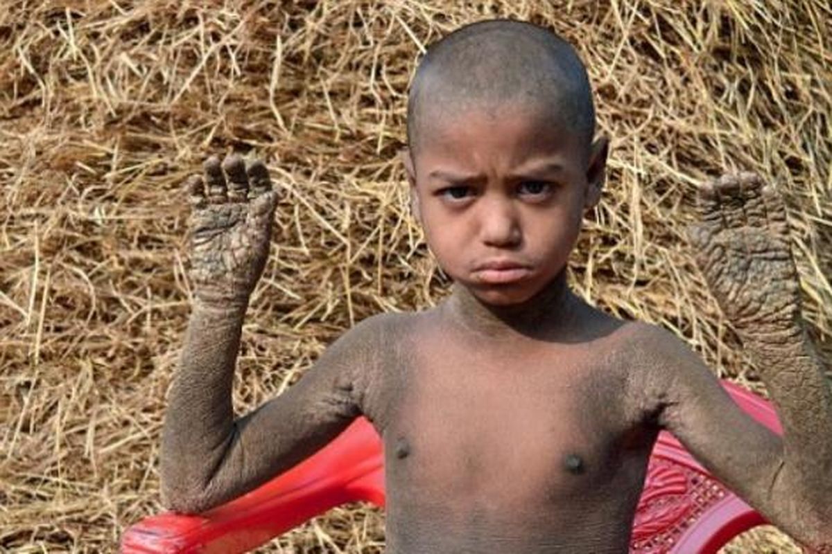 Mahendi Hassan, bocah 8 tahun yang mengalami penebalan kulit dan bersisik.