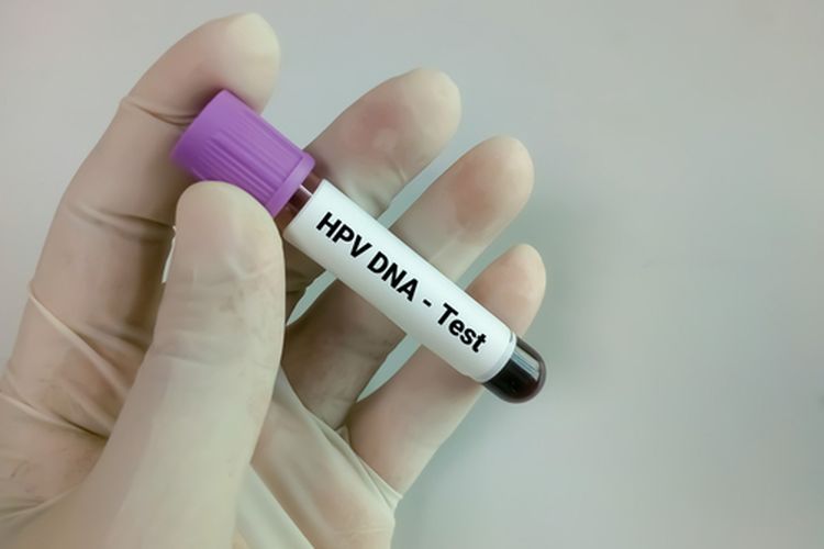 Ilustrasi tes HPV DNA, cara tes HPV DNA, cara pemeriksaan HPV DNA.  Kementerian Kesehatan secara bertahap menggunakan tes HPV DNA untuk mempercepat deteksi dini kanker serviks mulai 2023.