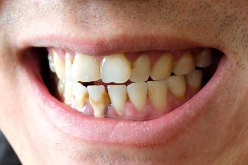 Apakah Scaling Gigi Bisa Pakai BPJS Kesehatan? 
