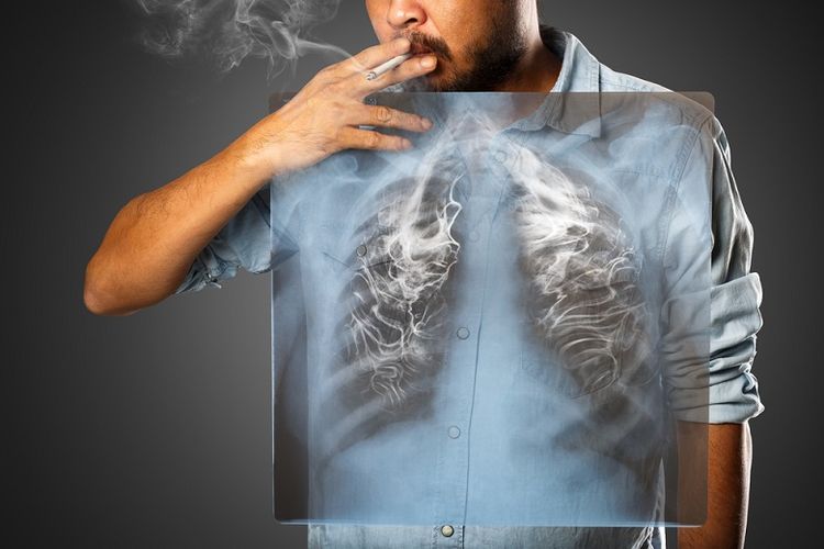 Asap rokok adalah penyebab utama kanker paru-paru. Jadi, cara untuk mencegah kanker paru-paru yang efektif adalah berhenti merokok dan menghindari paparan asap rokok. 