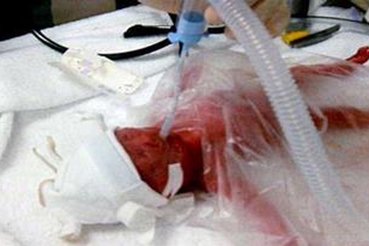 Bayi Lexi Lacey yang lahir dengan berat 396 gram.