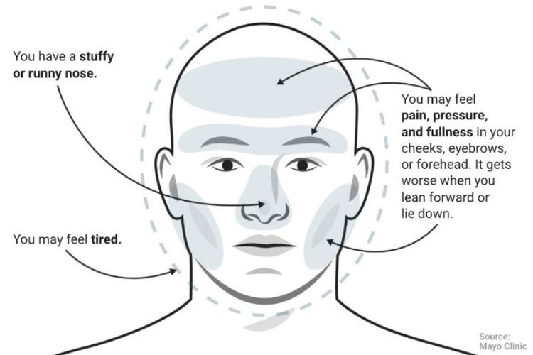 Sakit kepala sinusitis