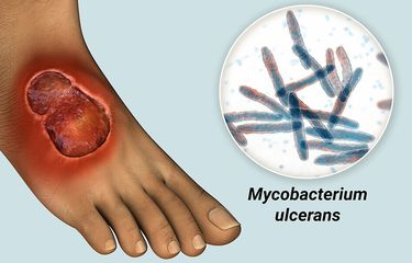Ilustrasi borok Buruli ulcer akibat bakteri Mycobacterium ulcerans