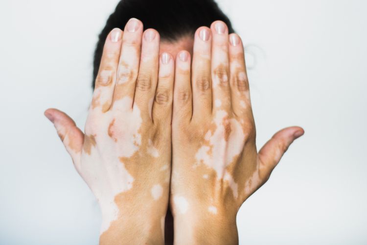 Vitiligo adalah penyakit yang menyebabkan hilangnya warna kulit. Ini muncul seperti bercak putih, bisa di tangan, kaki, wajah, dan selaput lendir.