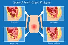 Pelvic Organ Prolapse