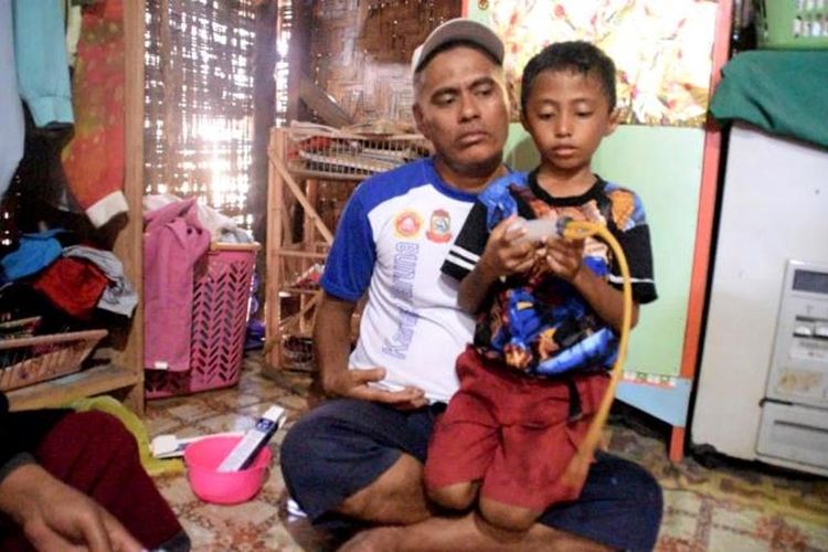 Abdul Alif (9) warga Dusun Lipu Mangau, Desa Lolibu, Kecamatan Lakudo, Kabupaten Buton Tengah, Sulawesi Tenggara, membutuhkan biaya pengobatan karena menderita penyakit langka