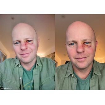 Perbandingan hasil foto dari kamera selfie Axon 20 5G (kiri) dengan iPhone 11 Pro (kanan).