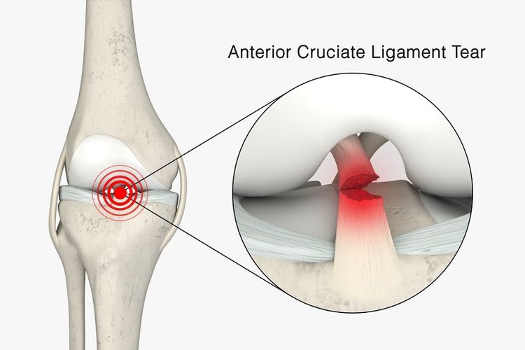 Ilustrasi cedera anterior cruciate ligament (ACL).